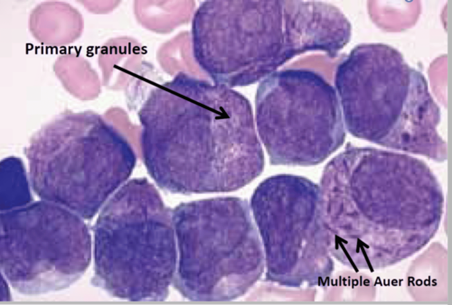 <p>promyelocytes with intracytoplasmic Auer rods</p><p>- clefted nucleus (hourglass-shape)</p><p>- can be hypogranular</p>