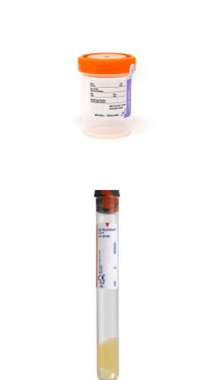 <p>SST or urine</p>