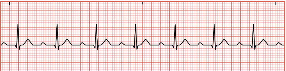 <p>occurs when cardiac conduction system is delayed in transmitting an electrical signal through the right atrium to the AV node, resulting in a PR interval greater than 0.20 seconds&nbsp;</p>