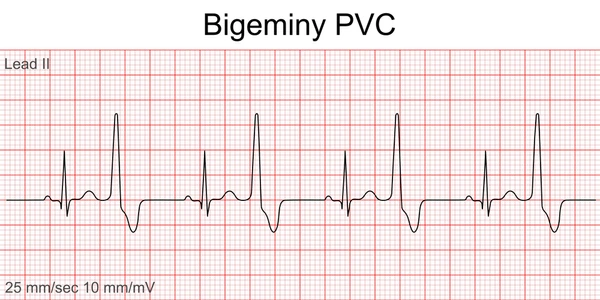 <p>consistent irregular heart rhythm that hits every other complex (1 gap)</p><p>2nd in the biz bigeminy</p>