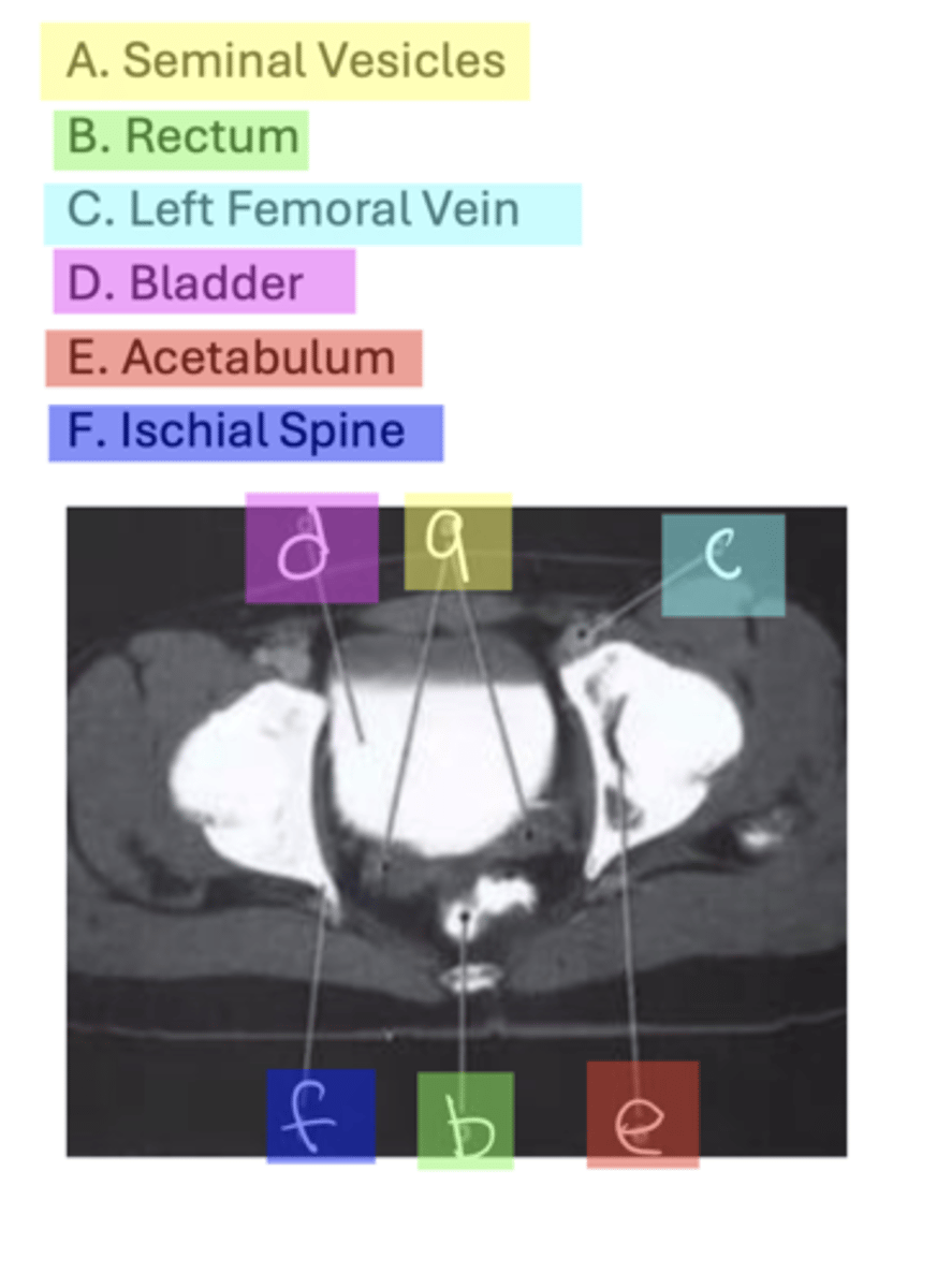 <p>A. Seminal Vesicles</p><p>B. Rectum</p><p>C. Left Femoral Vein D. Bladder</p><p>E. Acetabulum</p><p>F. Ischial Spine</p>