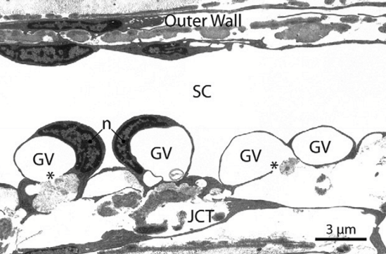 <p>Giant vacuoles </p>