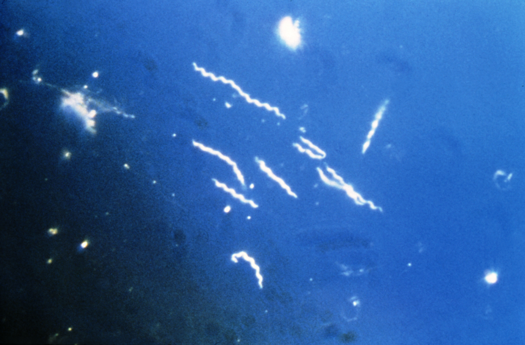 <p>Lyme disease; comes from ticks; causes confusion</p>