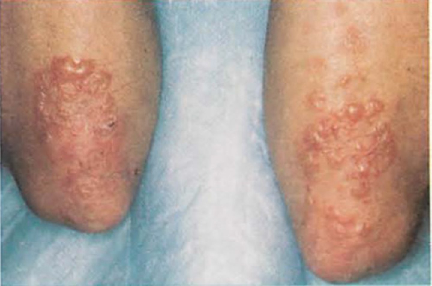 <p>diagnose this image</p><p>Chronic recurrent pruritic vesicular eruption on erythematous base in a symmetrical pattern</p>