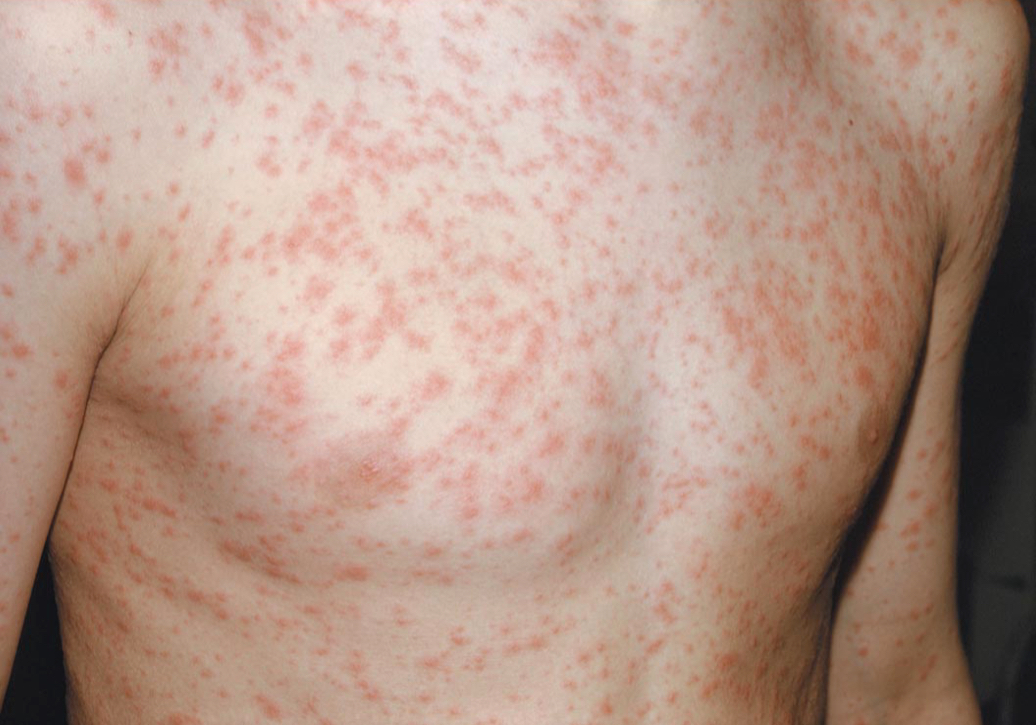 Rubella virus: Viral skin lesions