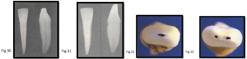 <p>canal anatomy of<strong> mn incisors</strong></p>