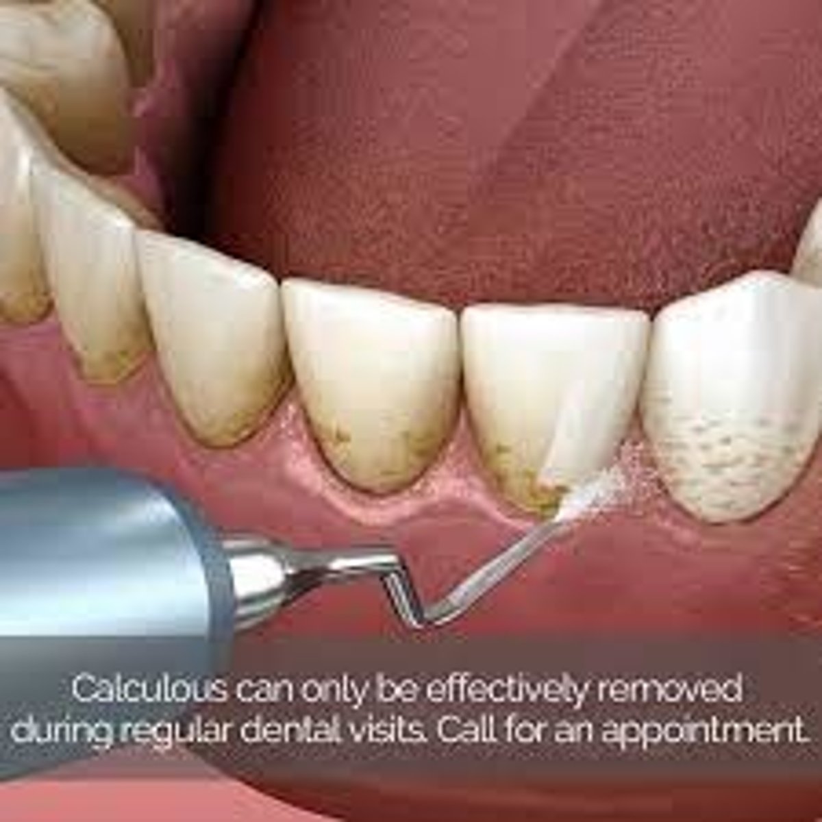 <p>tartar (hardened plaque, has to be removed with dental tools)</p>
