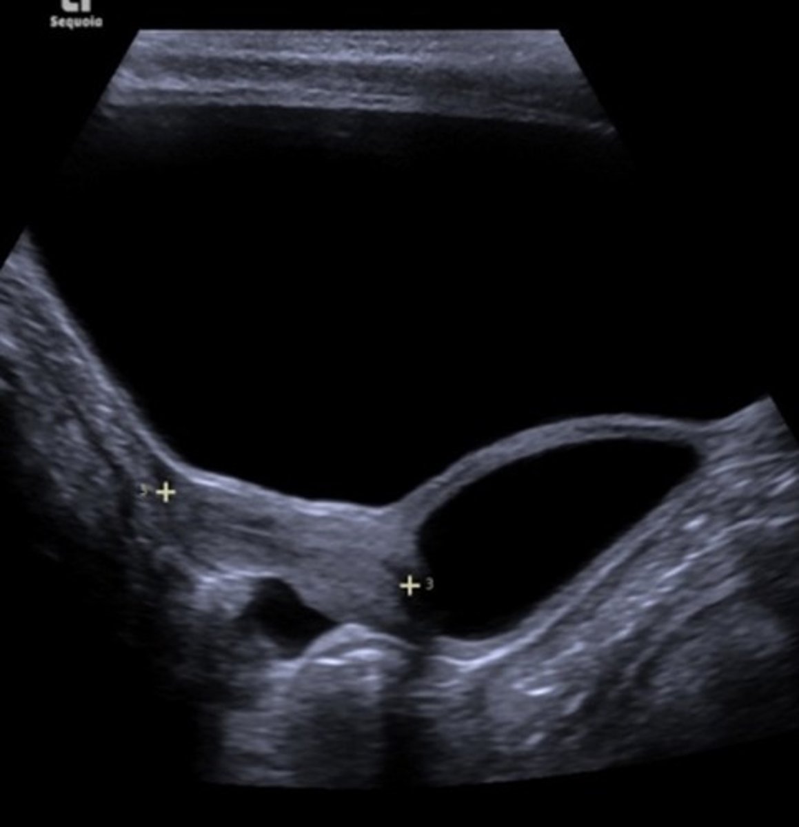 <p>Most common cystic lesion in vagina</p><p>Remnants of mesospheric ducts</p><p>Common in anterolateral portion of vagina</p>