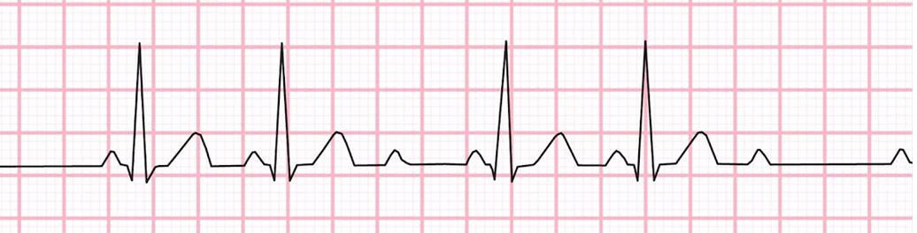 <p><span>The&nbsp;_____&nbsp;arrhythmia has no lengthening in the P-R intervals. It is characterized by a "lonely p wave" with no corresponding QRS complex. Please name the arrythmia shown below.&nbsp;</span></p>