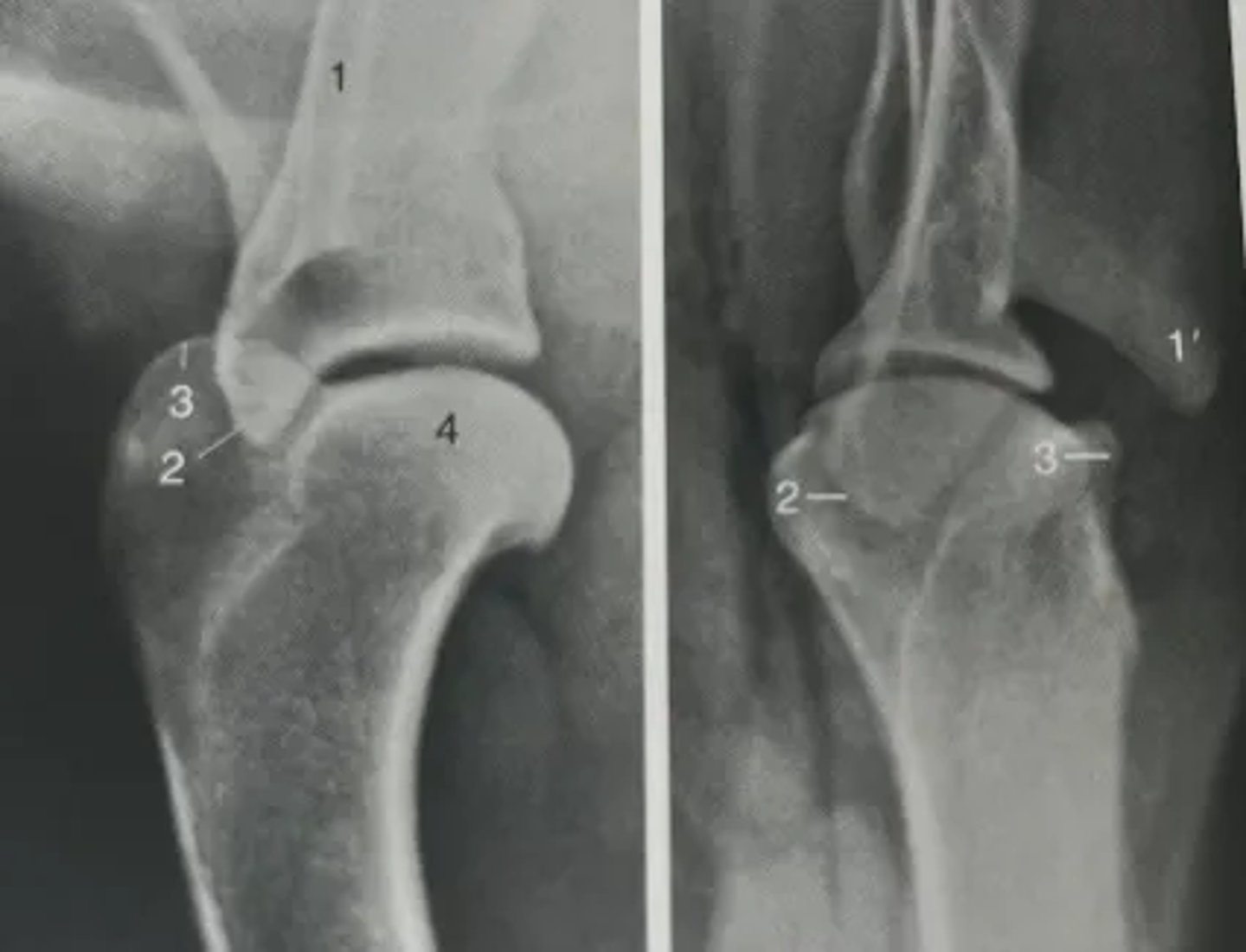 <p>1. Spine of scapula</p><p>1'. Acromion</p><p>2. Supraglenoid tubercle</p><p>3. Greater tubercle of humerus</p><p>4. Head of humerus</p>