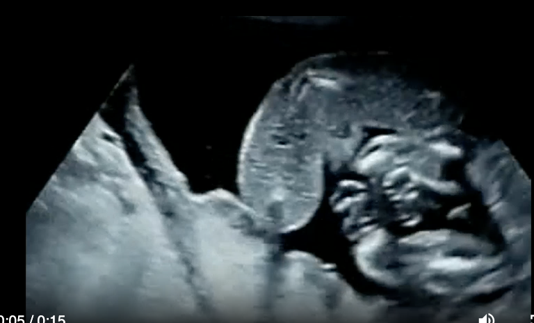 <p>a) twin reversed arterial perfusion sequence [<strong>TRAP</strong>]</p><p>b) twin anemia polycythemia sequence (<strong>TAP</strong>)</p><p>c) a triploidy fetus + normal fetus</p><p>d) vanishing twin syndrome</p>