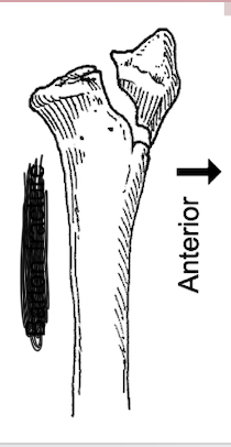 <p>What type of fracture is this?</p>