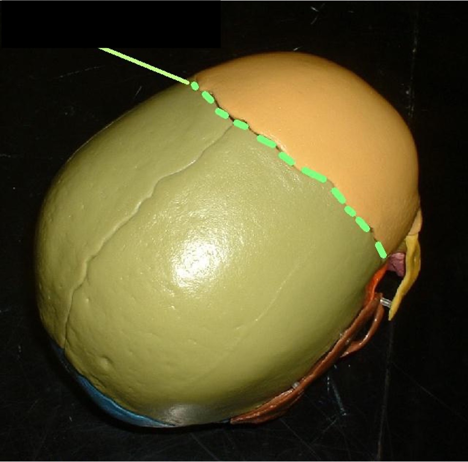 <p>The connection between the frontal bone and parietal bone (between the front and the back)</p>