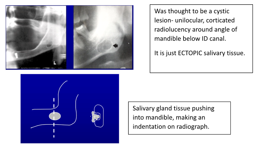 <ul><li><p>Unilocular</p></li><li><p>Corticated</p></li><li><p>Around angle of mandible</p></li><li><p>BELOW ID canal</p></li></ul><p></p><p>Its ectopic salivary gland tissue → pushes into mandible - causes indentation on radiograph</p>