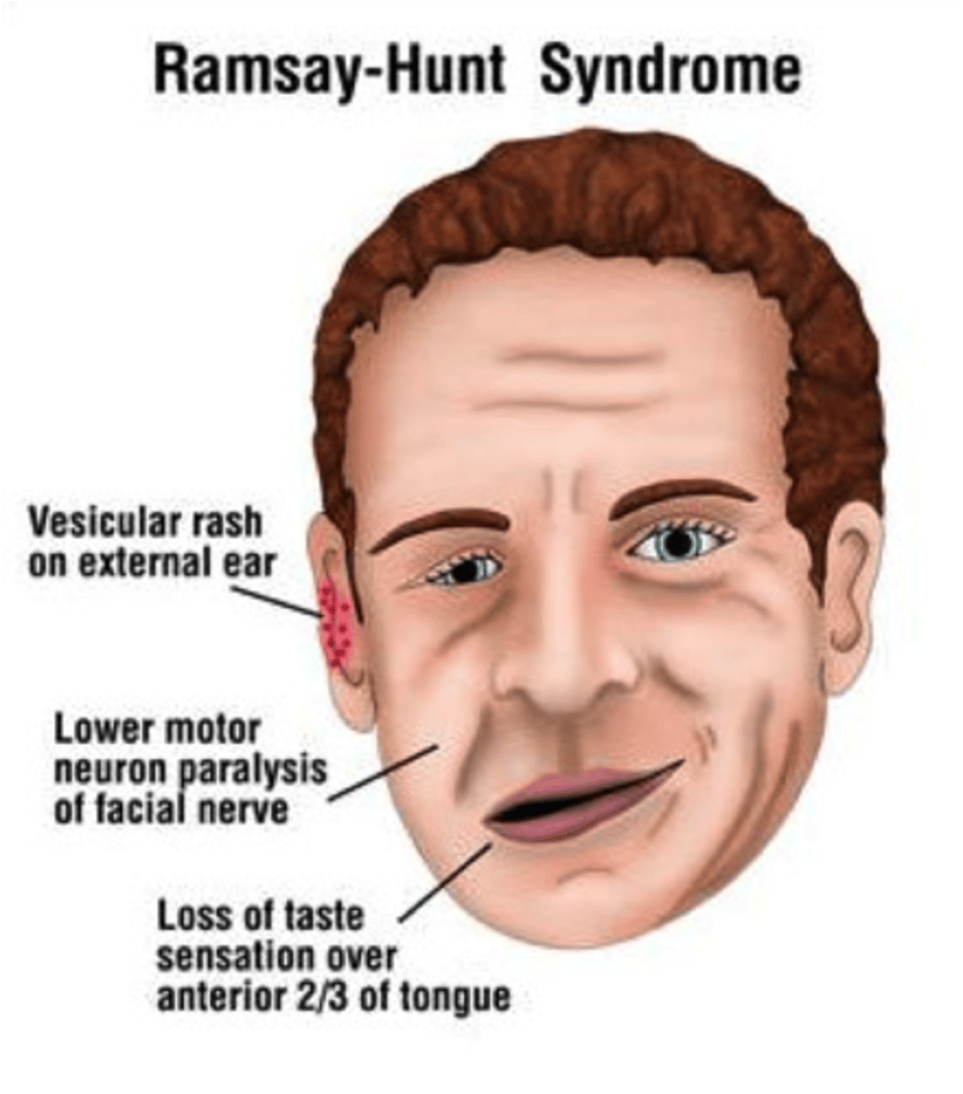 <p>Zoster Oticus (Ramsay-Hunt Syndrome)</p>