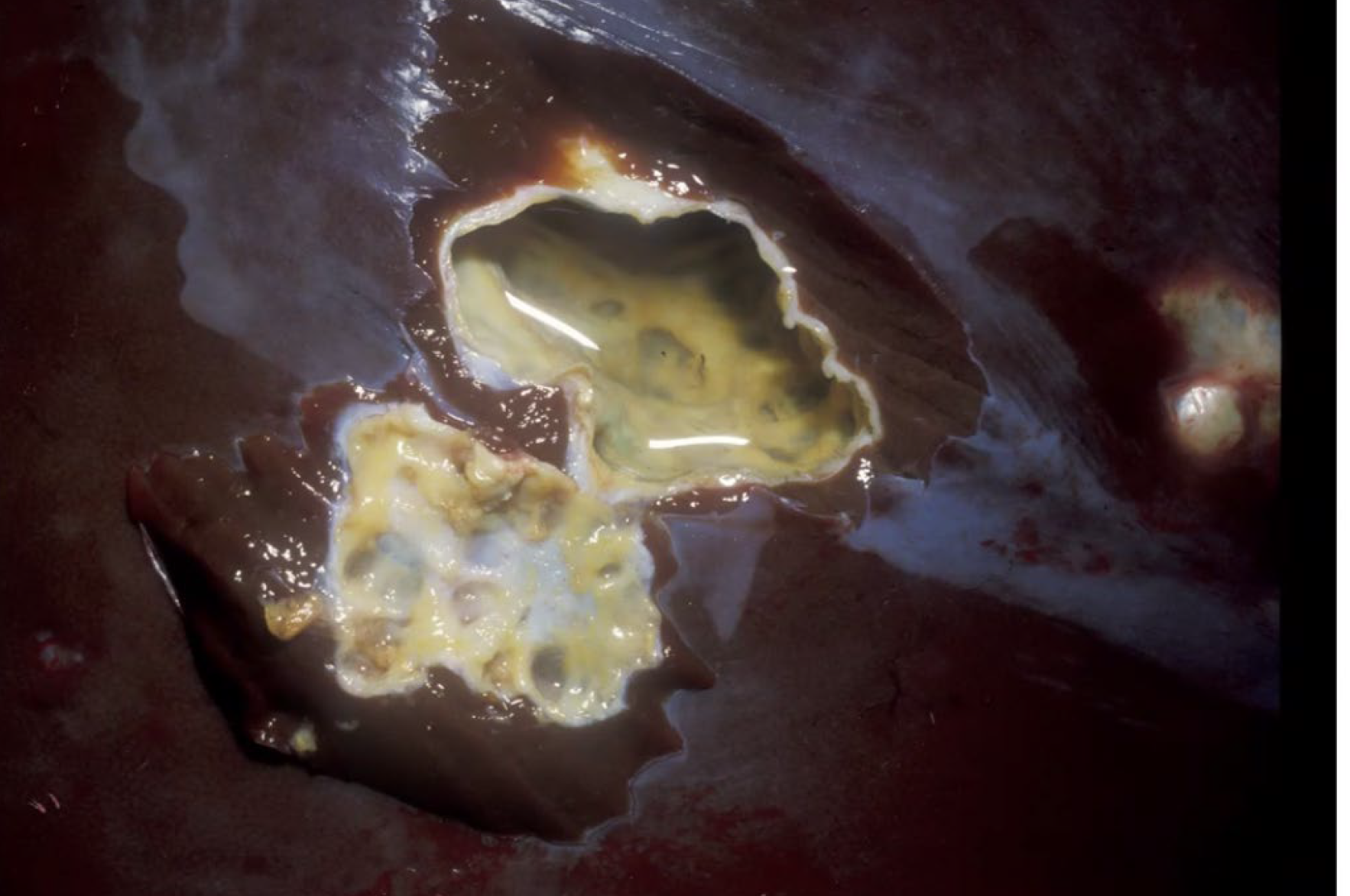 <p>What is the etiology?</p><p>A-Ecchinococcus granulosus</p><p>B-Cysticercus bovis</p><p>C-Paragonimus westermany</p><p>D-Dicroe/ium dendriticum</p>