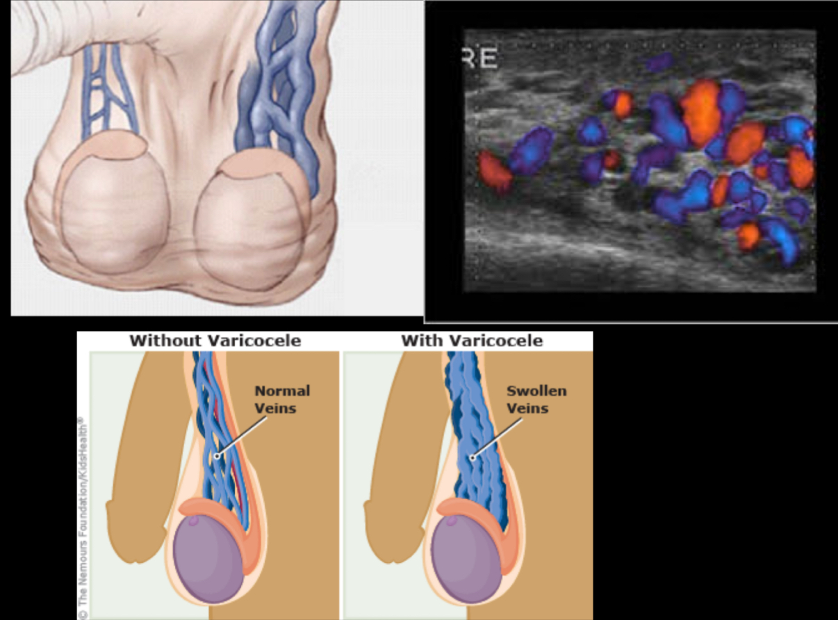 <p>What does the following describe?</p><p>• distend with Valsalva maneuver, standing, or abdominal compression</p><p>–May produce aching pain when standing for periods of time or after heavy lifting</p><p>•Most common correctable cause of male infertility – associated with infertility</p>