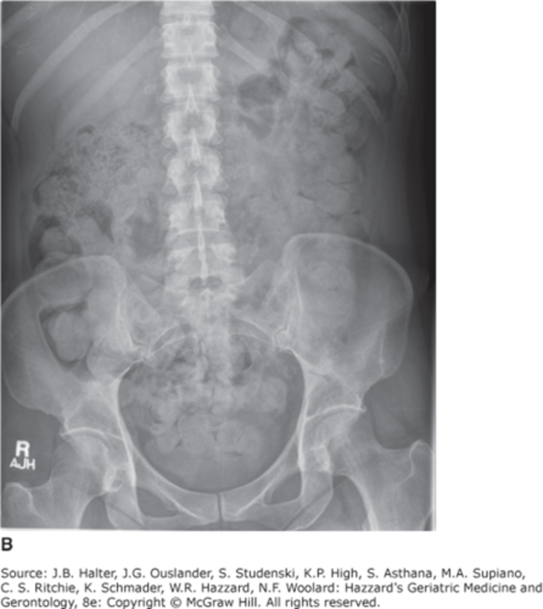 <p>air in distal rectum, no bowel obstruction present</p>
