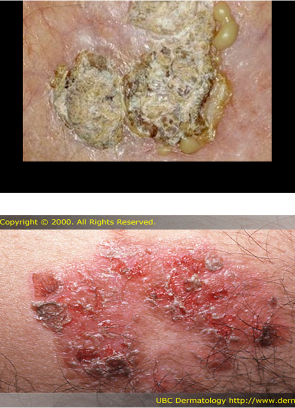 <p>dried serum or exudates on skin surface; present after blisters rupture</p>