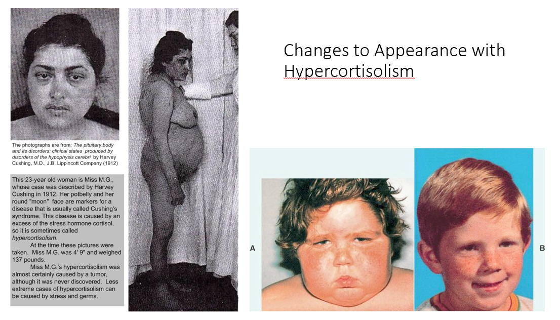 <ol><li><p>Chronic = decrease in bone density</p></li><li><p>Cortisol increases cardiac output via Alpha 1 Receptors!</p></li><li><p>Increased Cortisol = decrease in glucose uptake and insulin secretion. Decrease in GLUT 4 receptor expression.</p></li></ol><p></p>