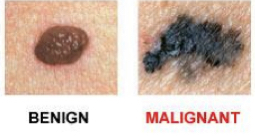 Caused by uva rays
Most deadly especially if it spreads to dermis
Caused my melanocytes in preexisting mole