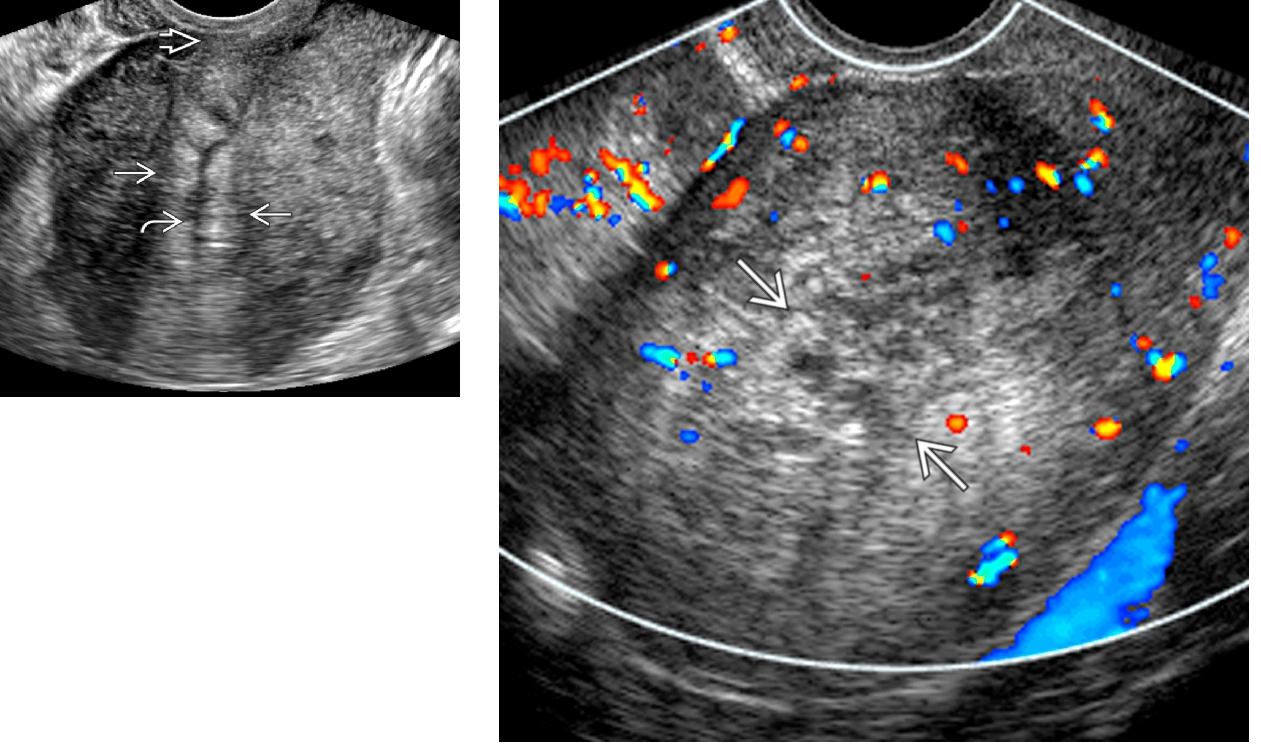 <ul><li><p><strong>POSTPARTUM patients</strong></p></li><li><p>PID pts</p></li><li><p>use of instrumentation causing infection </p><ul><li><p>fever / HIGH WBC</p></li><li><p>pelvic pain</p></li><li><p>low back pain</p></li><li><p>vaginal bleeding</p></li></ul></li></ul><p></p>