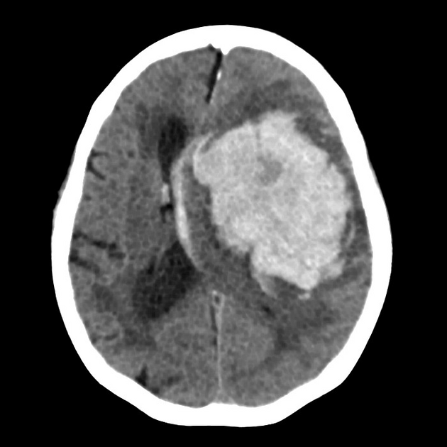<p>Intracerebral haemorrhage pathology </p>