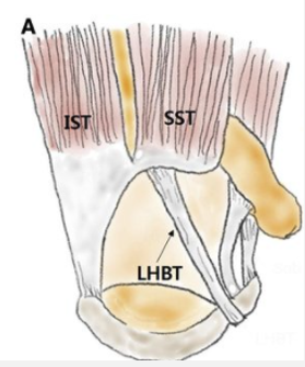 <p>Long Head of Biceps Tendinopathy biomechanical MOI &amp; comorbidity</p>