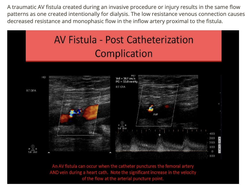 <p>d) monophasic w/increased diastolic </p>