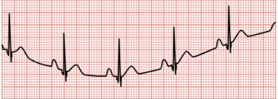 <p>Baseline wanders away from the center of the paper due to movement or poor electrode connection.</p>