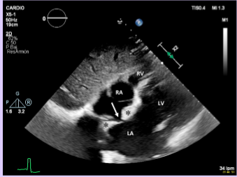 <p>Normal variant of the heart muscle that can be mistaken for a tumor.</p><p>Superior and inferior fatty portions of the IAS sparing the fossa ovalis region.</p><p>“Dumbbell” appearance</p>