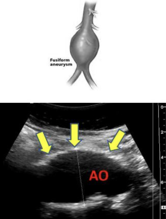<ul><li><p>circumferential enlargement of vessel with tapering at both ends</p></li><li><p>resembles a football</p></li></ul><p></p>