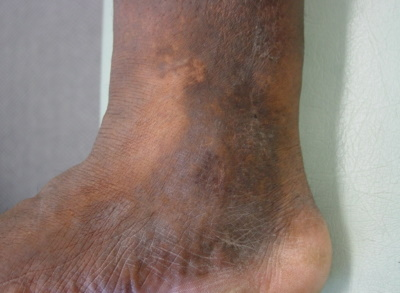 <p>Pain / leg swelling (worse on exercise) + itchy dry skin: DDx and Rx.</p>