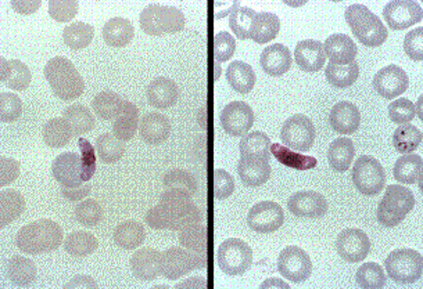 <p>c.P. falciparum.</p><p>P. falciparum invades RBCs of any age and, for this reason, often exhibits the highest parasitemia—reaching 50% in some cases. The ring forms of P. falciparum are more delicate than those of other species, often have two chromatin dots, and may show multiple ring forms in a single RBC. Gametocytes have a characteristic banana or crescent shape. </p>