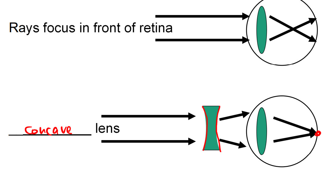 <p>lens focus the rays of light together before they reach the retina due to development shape of eyeball/lens </p><ul><li><p>can be fixed by glasses with a concave lens</p></li></ul><p></p>