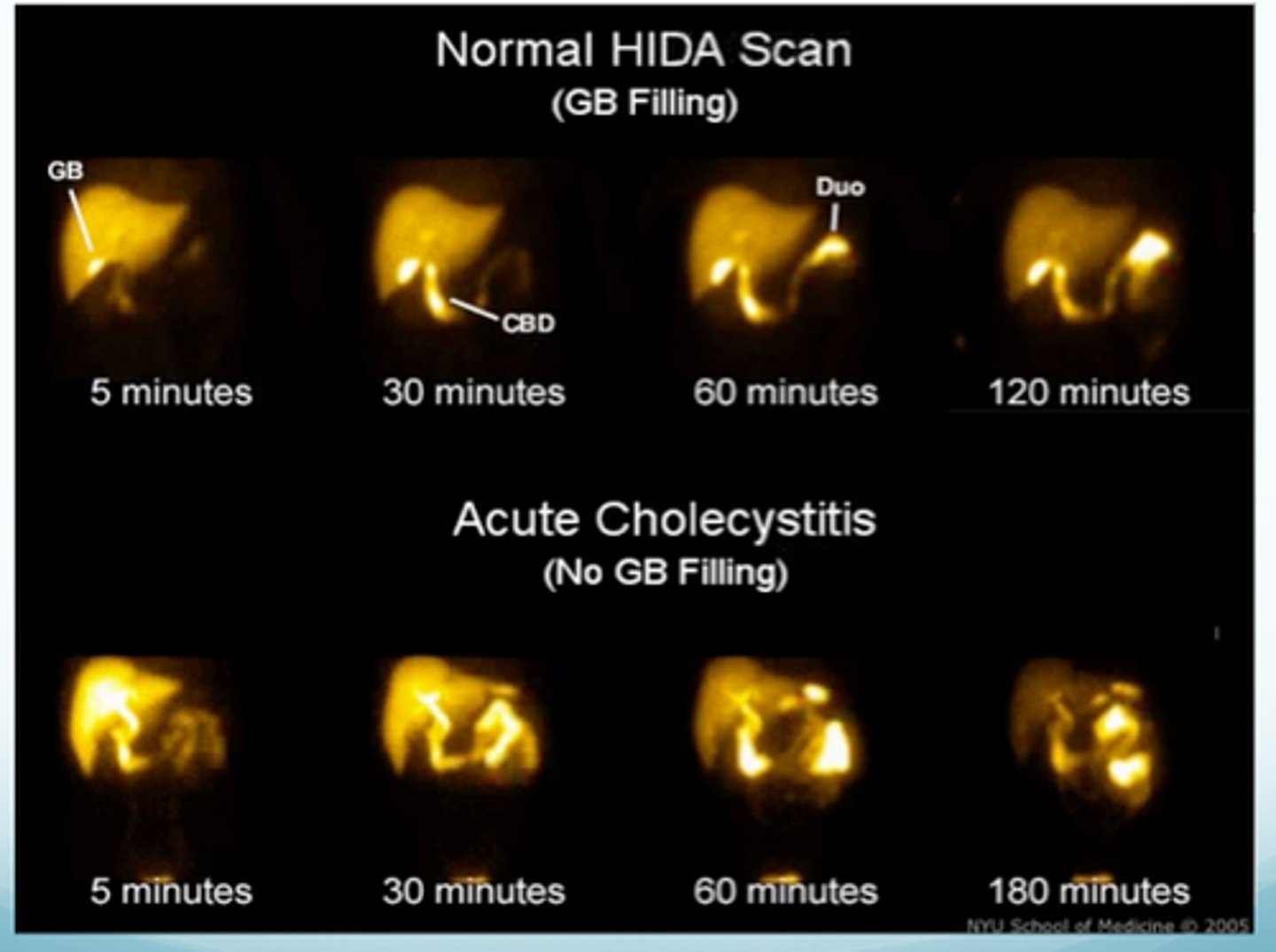 <p>Used to view gallbladder &amp; bile ducts</p><p>-Fast for 4 hours</p><p>-Inject HIDA (hepatobiliary iminodiacetic acid)</p>