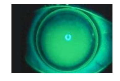 <p>4. How would you describe the fit of this lens? 1mark </p><p></p><p> Good alignment fit </p><p> Steep fitting </p><p> Flat fitting </p><p> Acceptable but slightly steep </p><p> Acceptable but slightly flat</p>