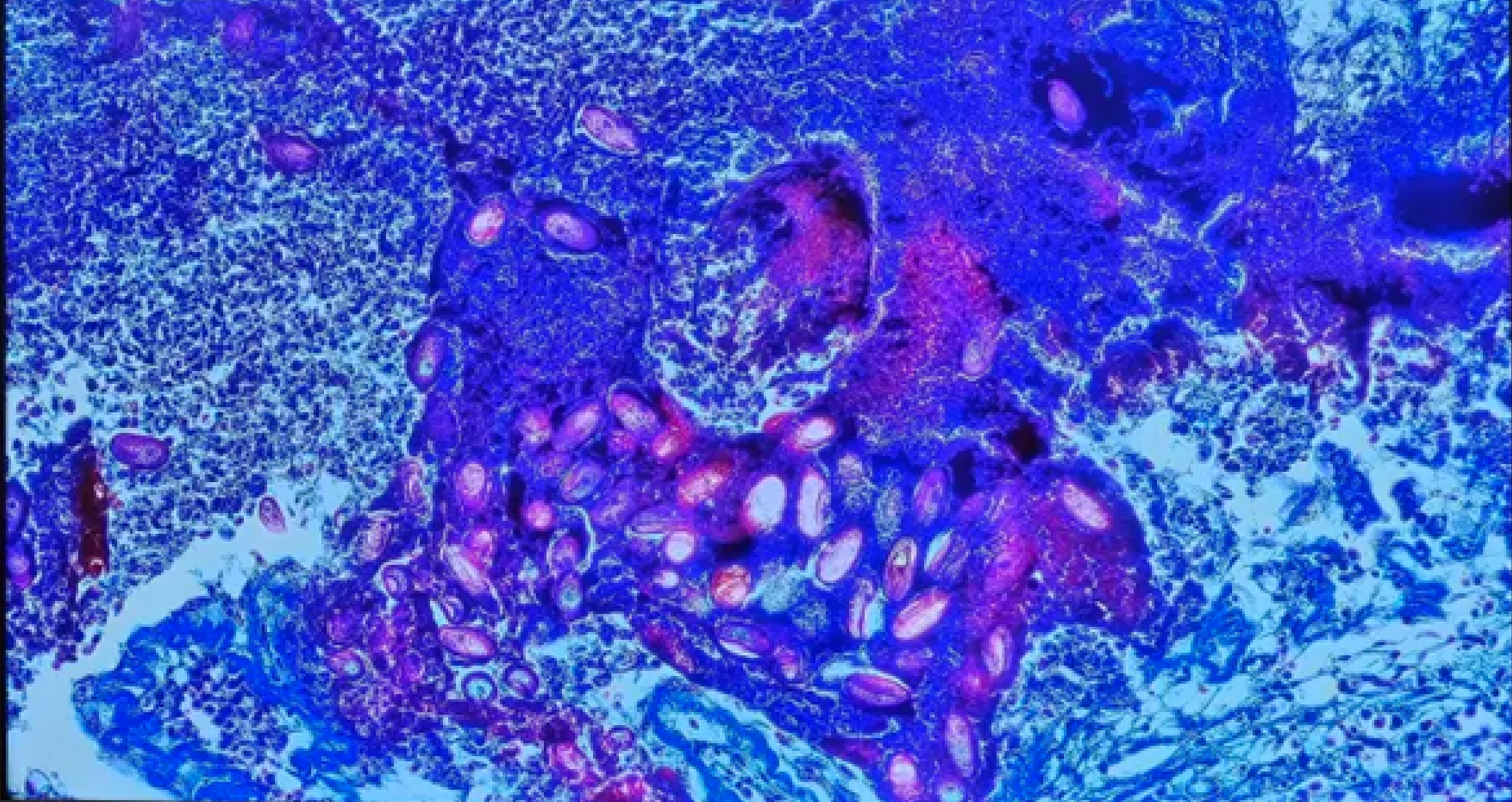 <p><span data-name="microscope" data-type="emoji">🔬</span><span data-name="petri_dish" data-type="emoji">🧫</span><strong><span> </span>Na podstawie zdjęcia preparatu:</strong></p><p></p><ul><li><p><span data-name="book" data-type="emoji">📖</span><span> </span>rozpoznaj gatunek pasożyta;</p></li></ul><p></p><ul><li><p><span data-name="recycle" data-type="emoji">♻</span><span> </span>rozpoznaj wszystkie formy rozwojowe;</p></li></ul><p></p><ul><li><p><span data-name="microbe" data-type="emoji">🦠</span><span> </span>wskaż organelle i cechy charakterystyczne dla danego gatunku;</p></li></ul><p></p><ul><li><p><span data-name="mask" data-type="emoji">😷</span><span> </span>nazwij chorobę, którą pasożyt wywołuje.</p></li></ul><p></p>