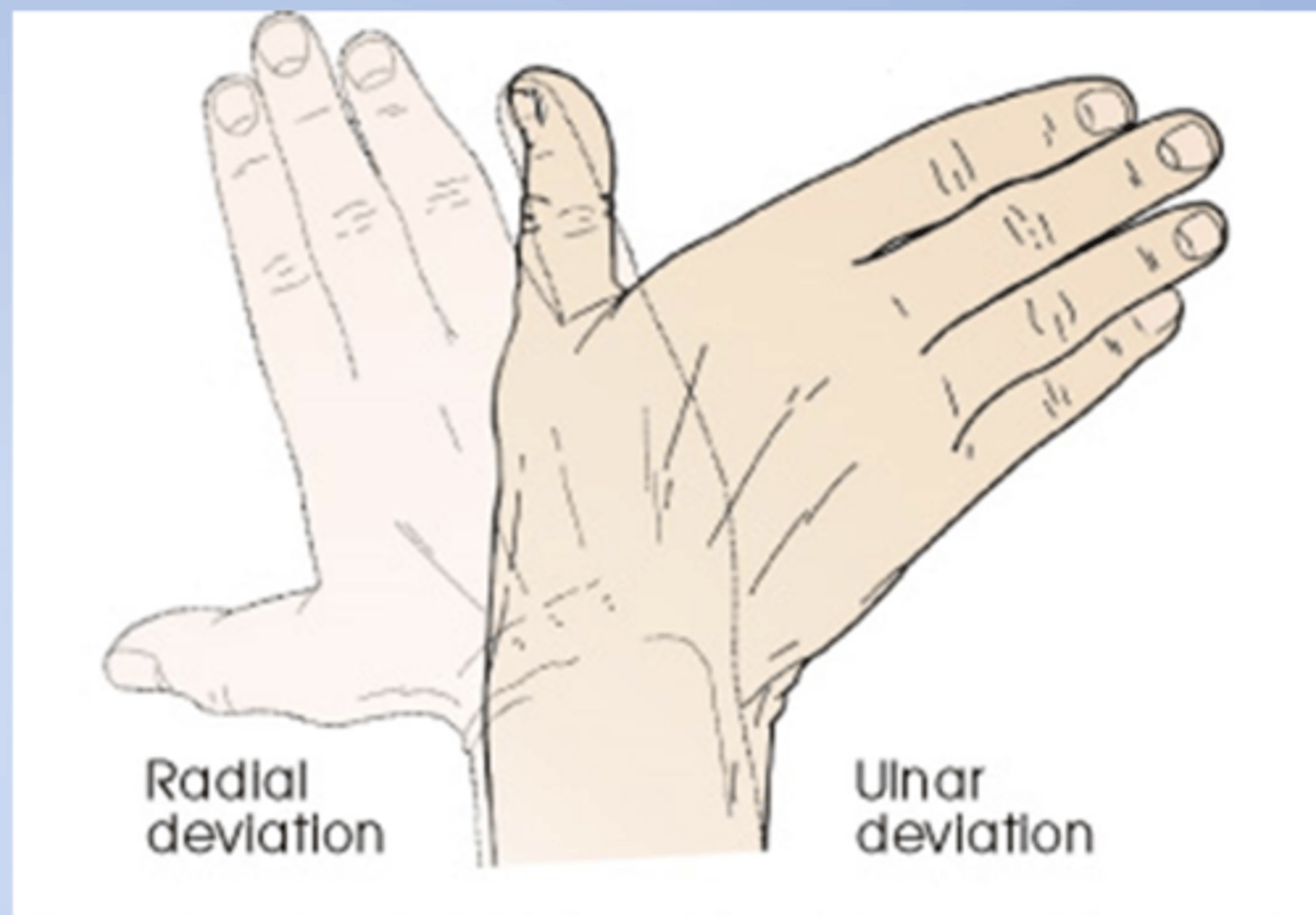 <p>a turning away from the regular or standard course</p><p>Radial deviation of the hand (turned to the</p><p>radial side) and ulnar deviation (turned to</p><p>the ulnar side).</p>