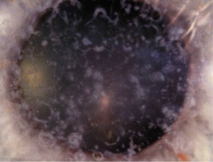 <ul><li><p>epithelial-stromal dystrophy</p></li><li><p>bilateral</p></li><li><p>onset: 1st decade, but not born with corneal signs</p></li><li><p><span>Bowman layer is replaced by connective tissue bands</span></p></li><li><p><span><strong>Symptoms</strong>: more symptomatic than epithelial dystrophies</span></p><ul><li><p><span>Visual complaints: blurred vision, photophobia and diplopia</span></p></li><li><p><span>Foreign body sensation and pain often due to RCE</span></p></li></ul></li><li><p><span><strong>Presentation</strong>: grey-white geographic subepithelial opacities</span></p><ul><li><p>more dense central</p></li><li><p>denser w/ age and for a reticular pattern (cause stromal haze)</p></li><li><p><em>rod</em>-like appearance</p></li><li><p><span><em>Corneal sensitivity will be reduced*</em></span></p></li><li><p><span>inc. corneal thickness</span></p></li><li><p><span>irregular astigmatism</span></p></li></ul></li></ul><p></p>