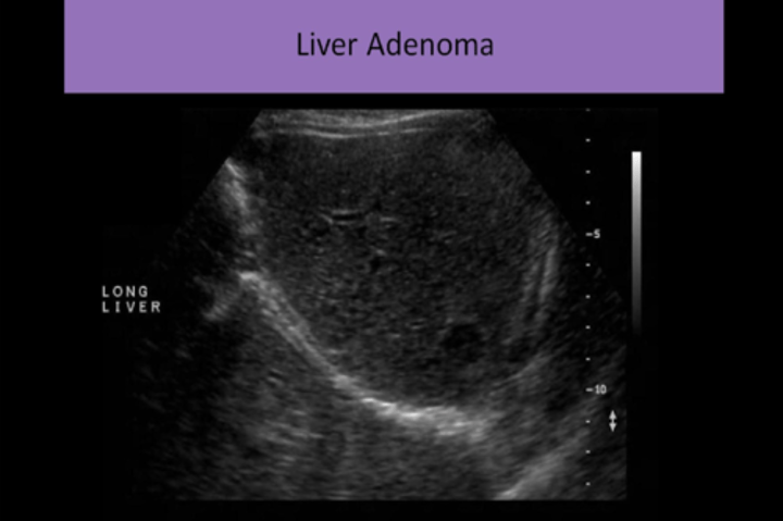 <p>1. UNCOMMON TUMOR<br>2. BILE DUCTS and KUPFFER CELL are ABSENT OR FEW IN NUMBER<br>3. ENCAPSULATED<br>4. more common in FEMALES<br>5. STRONG ASSOCIATION WITH ORAL CONTRACEPTIVES<br>6. also associated with GLYCOGEN STORAGE DISEASE<br>7. usually ASYMPTOMATIC, but MOST COMMON SYMPTOM is MASS IN RUQ<br>8. NORMAL LFTs<br>9. COLD NODULE on sulfur colloid imaging<br>10. SURGICAL INTERVENTION RECOMMENDED due to risk of hemorrhaging and malignant transformation</p>