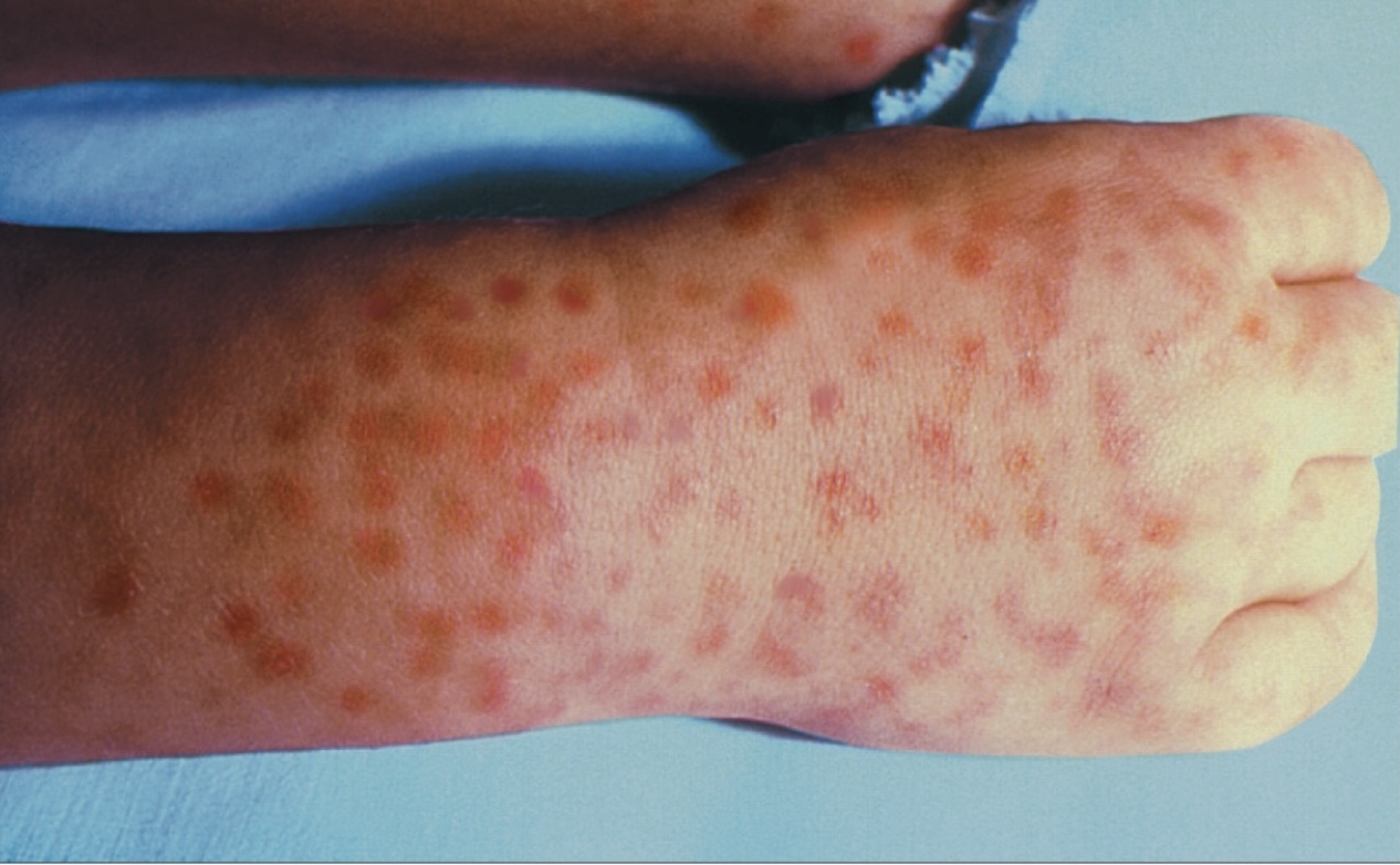 <p>Agent: <em><span>Rikketsia ricketsii</span></em></p><p><em><span>-</span></em> transmitted through tick bites.</p><p>Symptoms; fever, headache, and a spotted rash.</p>