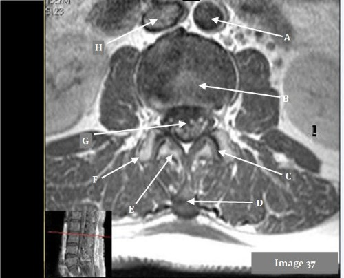 <p>Letter C in Image 37 is pointing to:</p><p>A. Facet joint</p><p>B. Intervertebral disc</p><p>C. Transverse process</p><p>D. Spinous process</p><p>E. Spinal cord</p>
