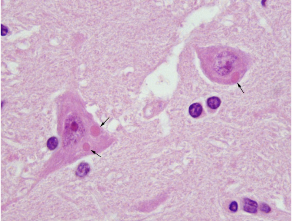 <p>a patient with a suspected case of rabies died in the hospital last night. to confirm the diagnosis, a histological section of brain tissue was stained, and the following was observed. based on these results, was the diagnosis of rabies confirmed? why or why not?</p>
