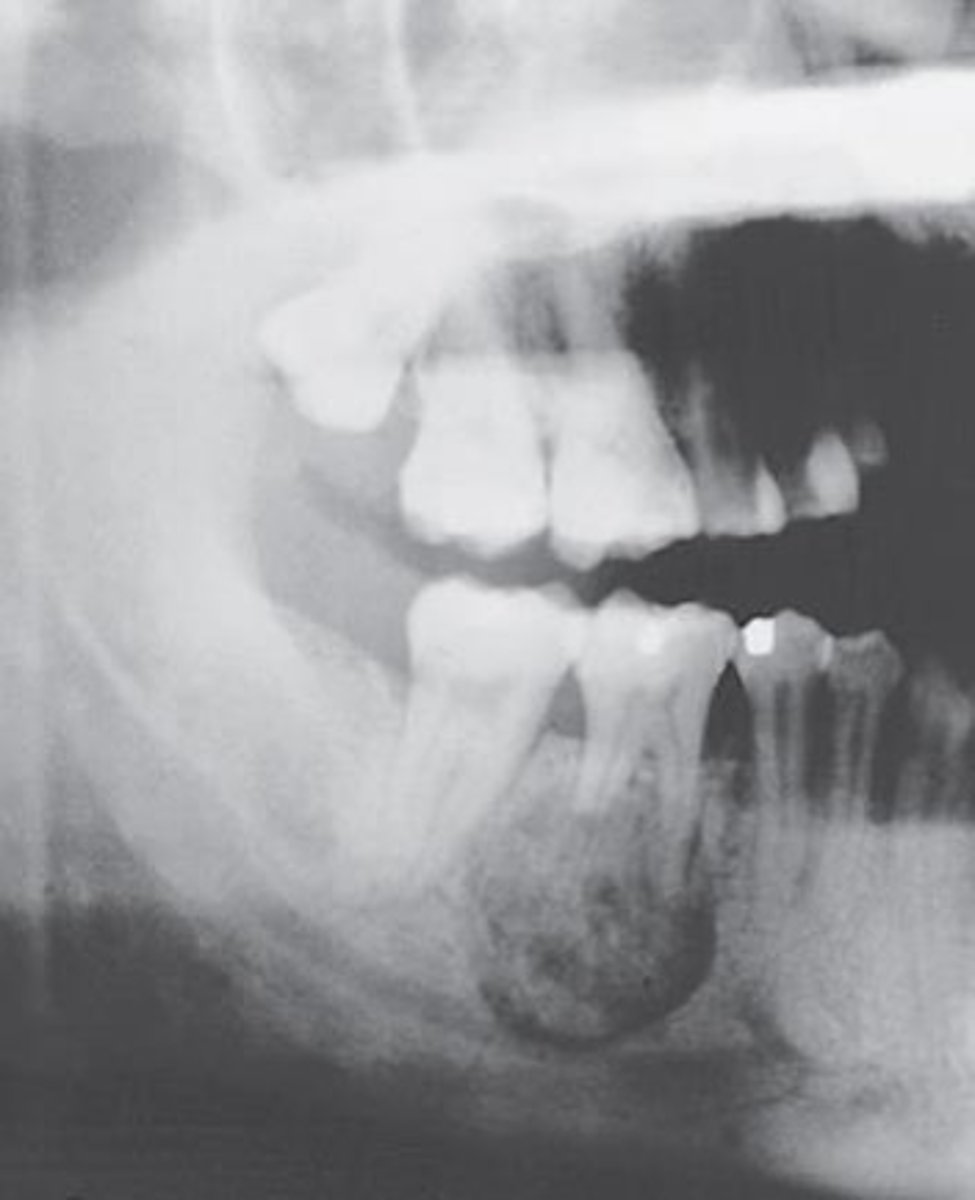 <p>-shows a well circumscribed radiopaque mass surrounded by a radiolucent halo and attached to the root of a mandibular first molar</p><p>-pain is a frequent symptom</p><p>-occurs in young adults and most occur in patients under 30</p>