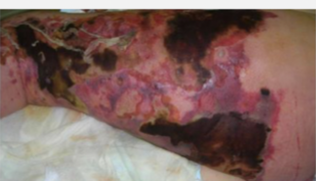 <p>35 y/o patient presents to the ED for leg pain. He states that he was out surfing yesterday and caught his leg on his board. Vitals are as follows, 90/63, 134 bpm, 103.5 temp. On physical exam you note blackish blisters on the skin that when pressed feel like rice krispies - when you do this your patient screams. What diagnostics do you want?</p>