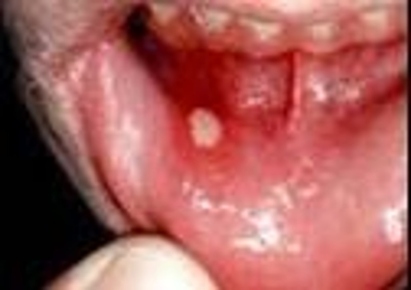 <p>major apthous ulcers</p>