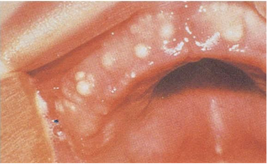 <p>The mother of a 1 month old baby has a concern of white nodules in the mouth of her kid. The clinical image is shown below. There is no pain or any other symptoms. Provide diagnosis</p>