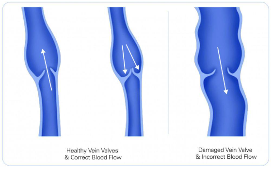 <p>Identify what is true in this condition represented in image with damaged valves. </p>