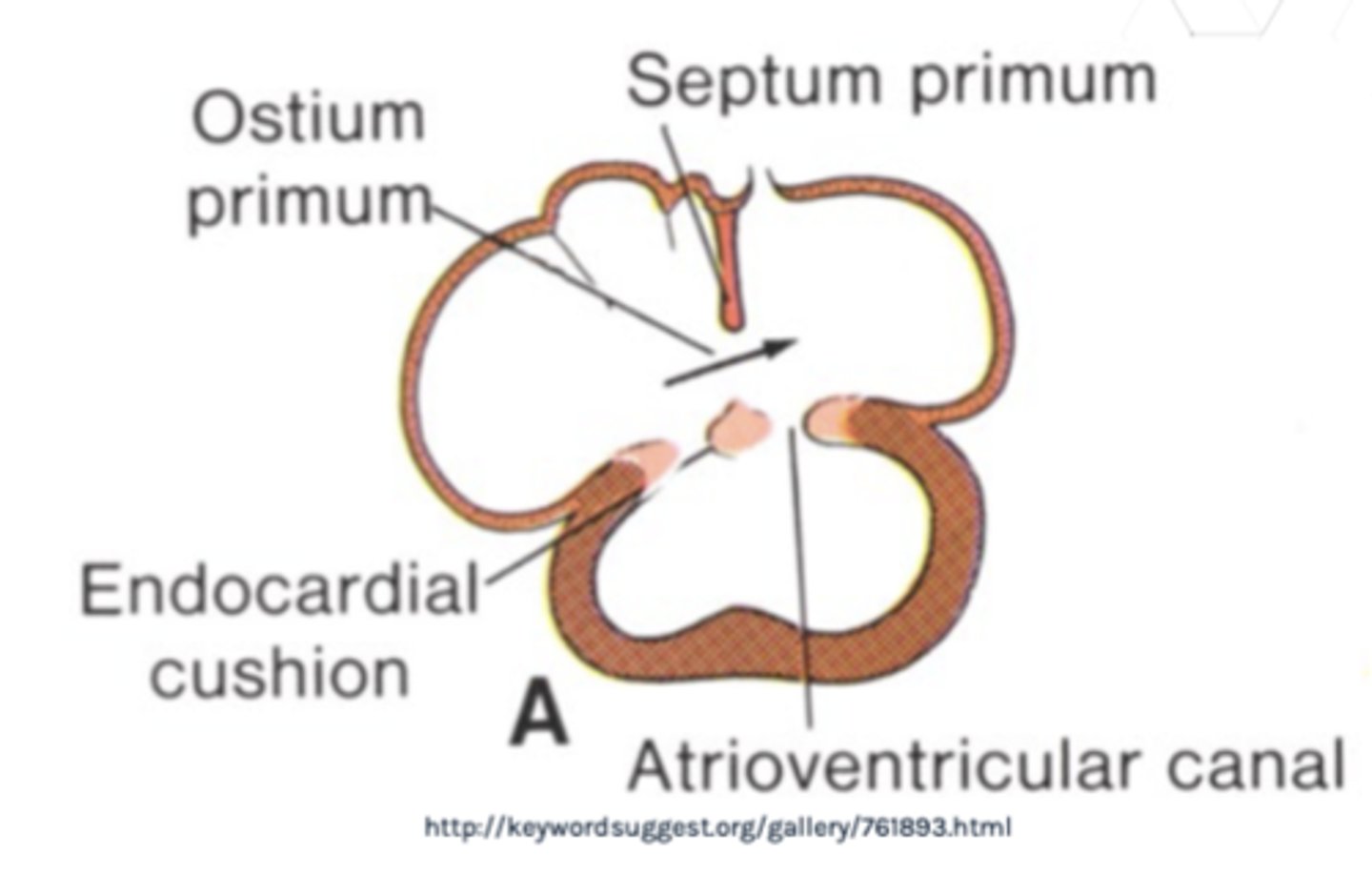 <p>endocardial cushion defects (partial, transitional, complete)</p>